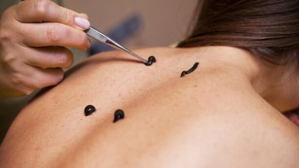 гирудотерапия гирудотерапия