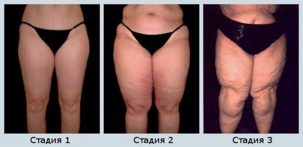 limfostaz-nizhnih-konechnostej лимфостаз