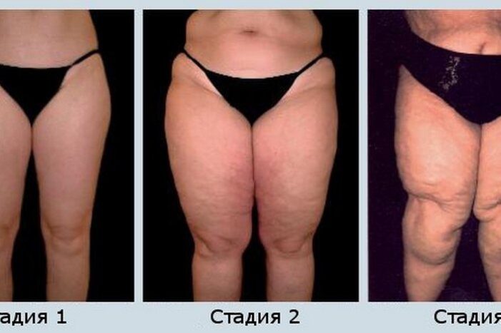 limfostaz-nizhnih-konechnostej лимфостаз