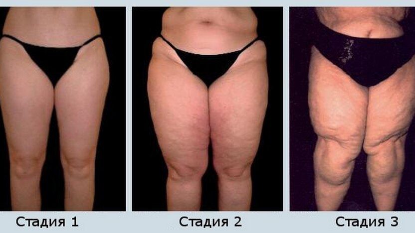 limfostaz-nizhnih-konechnostej лимфостаз