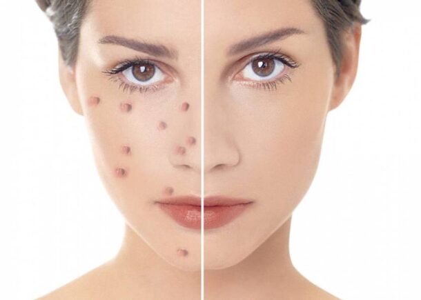 угревая сыпь лечение от угрей