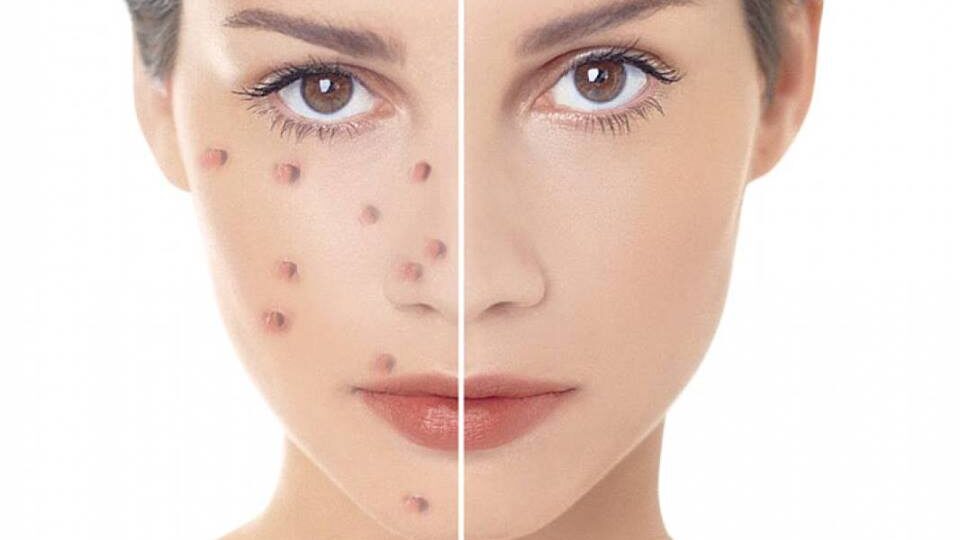 угревая сыпь лечение от угрей