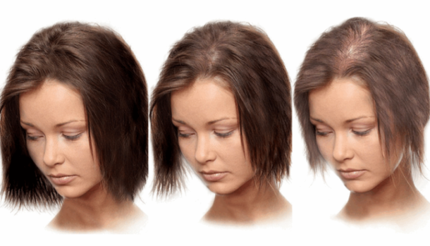 alopeziya