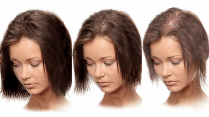 alopeziya
