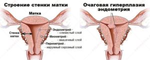 гиперплазия эндометрия