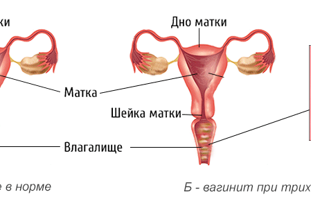 vaginit lecheniye vaginit lecheniye