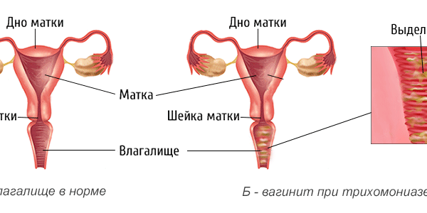 vaginit lecheniye