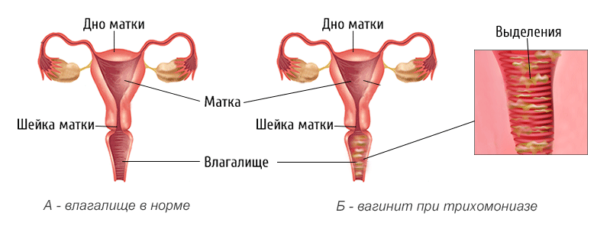 vaginit lecheniye vaginit lecheniye