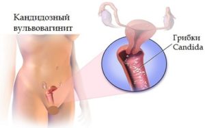 вульвовагинит