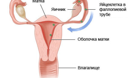 amenoria аменорея