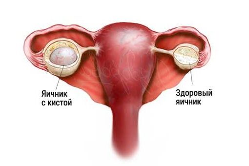 kista_yaichnika киста яичника