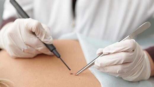 udalenie-kondilom удаление-кондилом