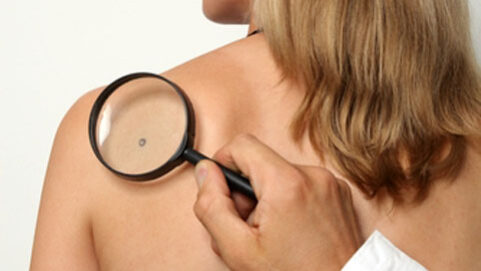 удаление_бородавок