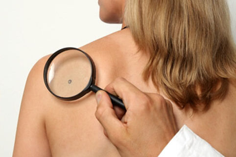 удаление_бородавок