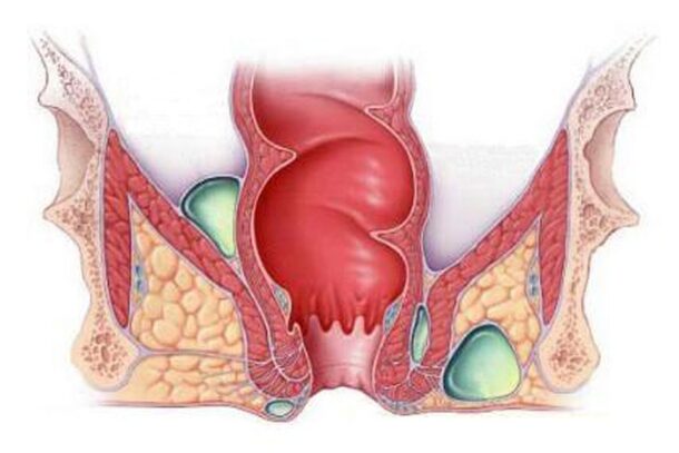 rectalnii-svish ректальный-свищ