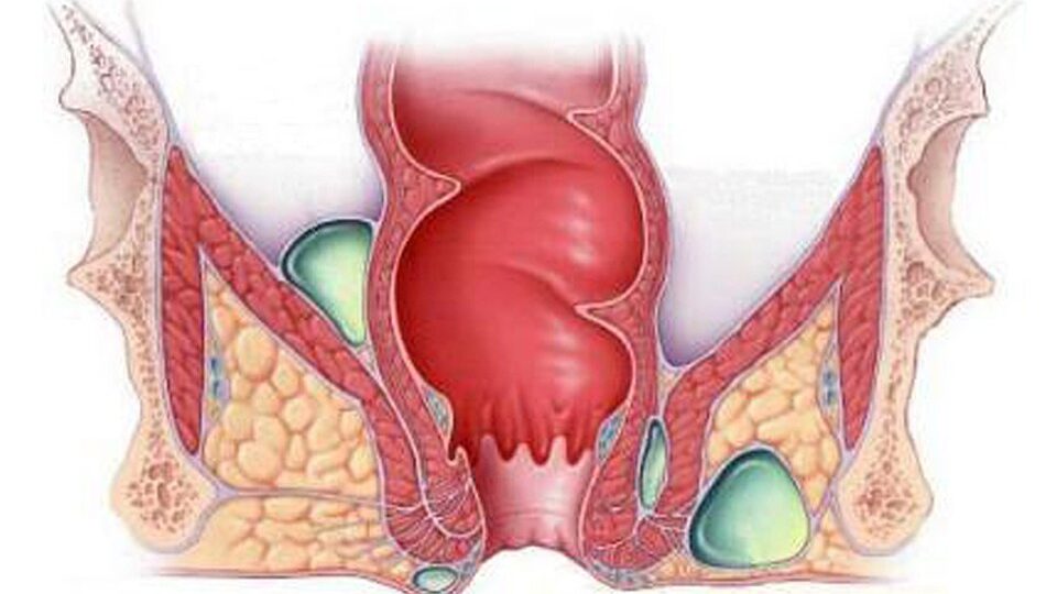 Геморрой: симптомы и методы лечения