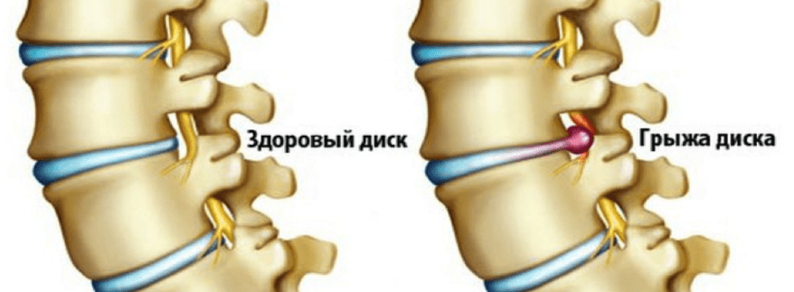грыжи-межпозвоночных-дисков