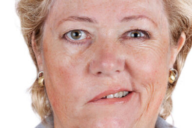 nevrit_licevogo-nerva неврит-лицевого-нерва