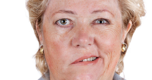 nevrit_licevogo-nerva неврит-лицевого-нерва