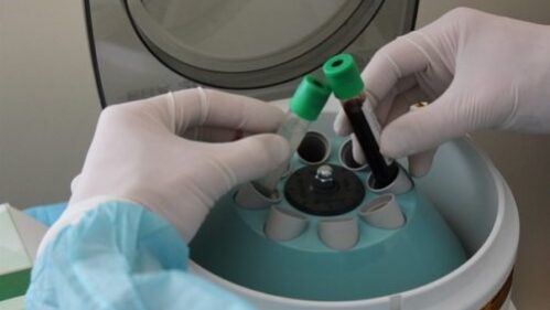 плазмолифтинг рук