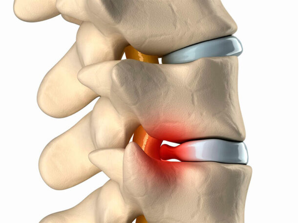 radikulit радикулит