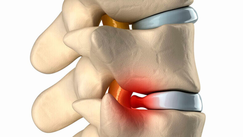 radikulit радикулит