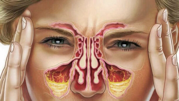 gaimorit гайморит