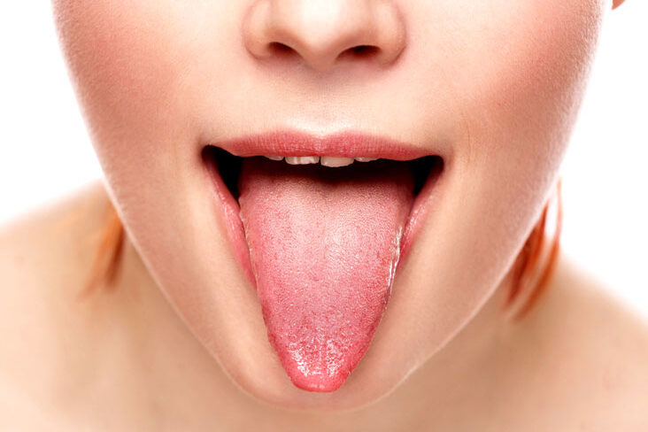 glossit глоссит