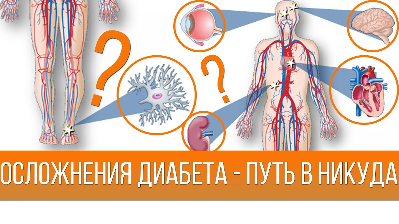 Последствия сахарного диабета картинки