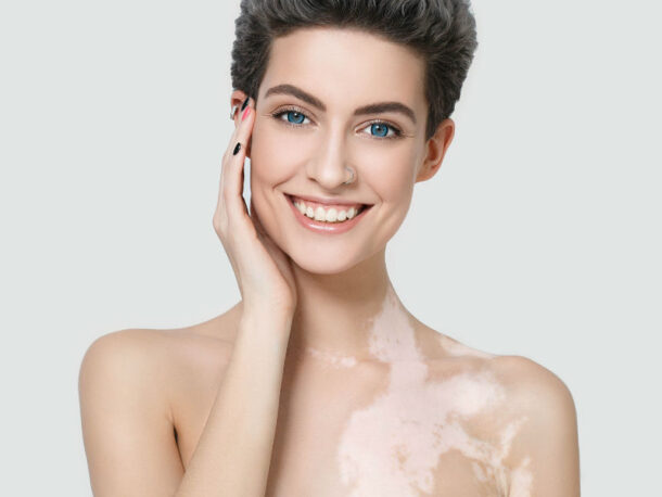 lechenie-vitiligo лечение-витилиго