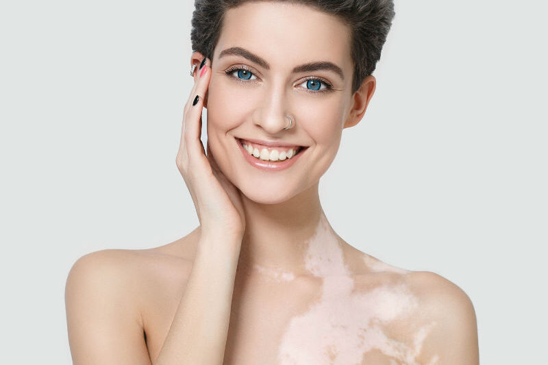 лечение-витилиго