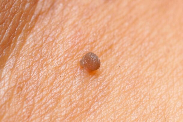 glisti-i-papillomi глисты-и-папилломы