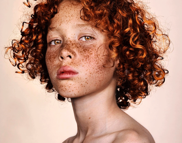 lechenie_pigmentacii лечение-пигментации