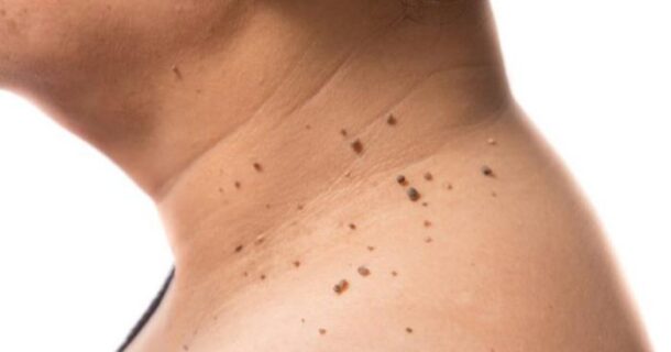 mnozhestvenie-papillomi множественные папилломы