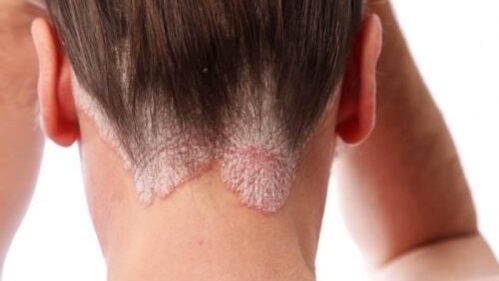 kak razvivaetsya psoriaz как развивается псориаз