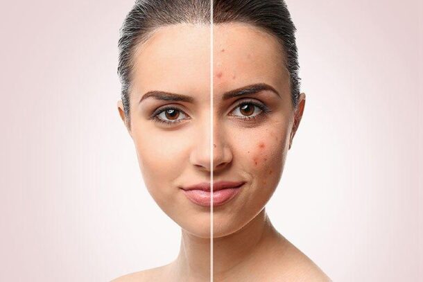 postakne постакне