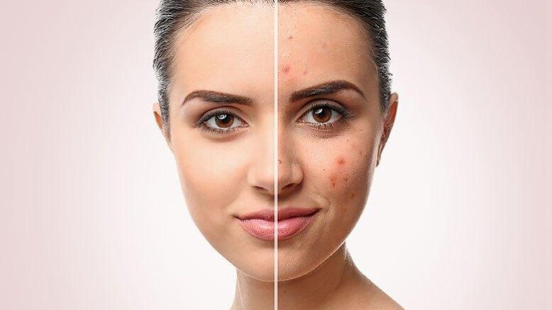 postakne постакне