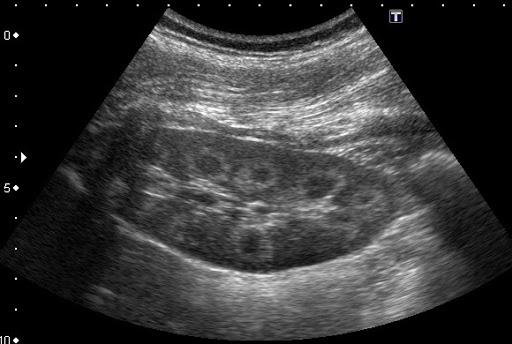 uzi pochek узи почек