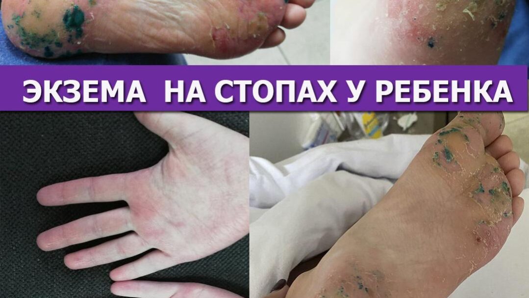 Экзема у детей: причины, диагностика, лечение - Медицинский центр ...