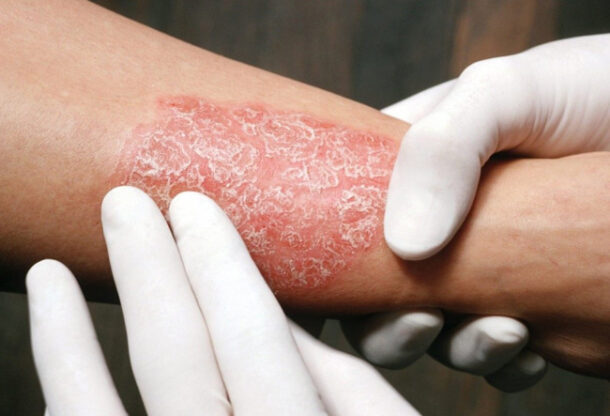 псориаз у ребенка псориаз у детей