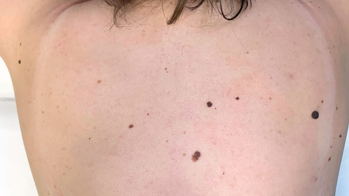 меланома кожи