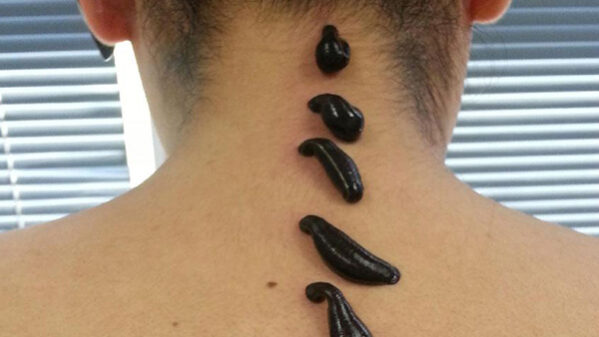 гирудотерапия