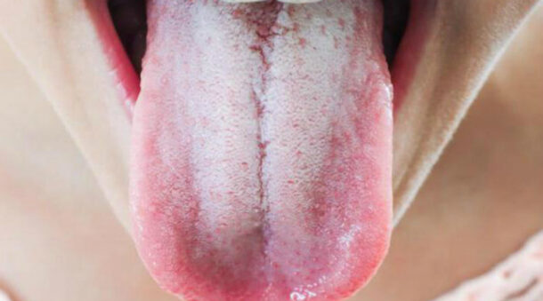 налет на языке налет на языке