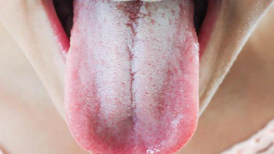 налет на языке