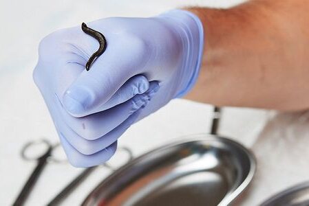 гирудотерапия при гипертонии