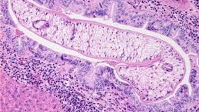 гастродискоидоз