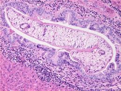 гастродискоидоз