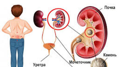 Диета при оксалатных, уратных, фосфатных камнях в почках и после дробления камней