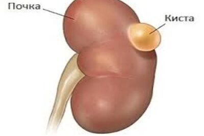 кисты почек