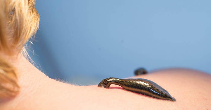 гирудотерапия при гипертонии гирудотерапия при гипертонии